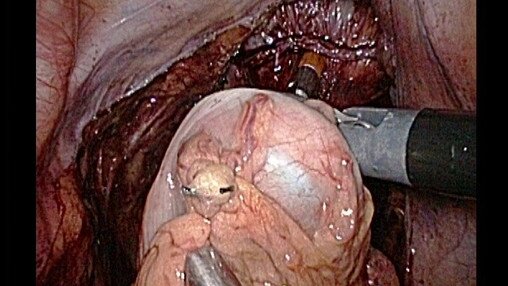 直腸癌治療簡介