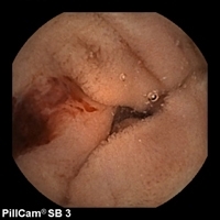 Obscure gastrointestinal bleeding