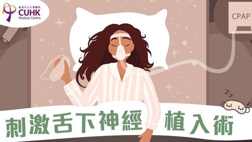 刺激舌下神經植入術