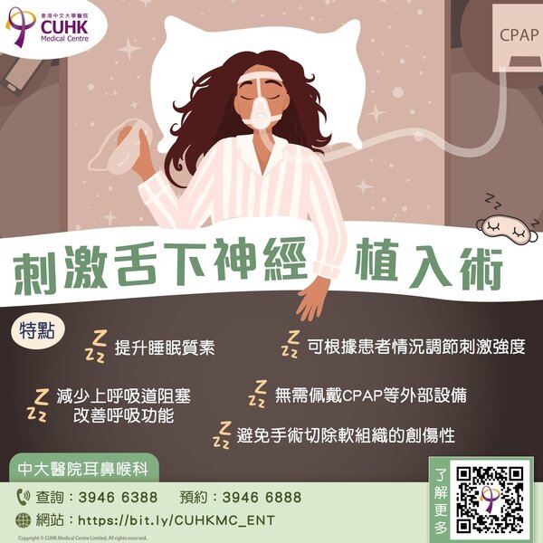 刺激舌下神經植入術