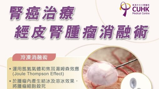 腎癌治療 - 經皮腎腫瘤消融術治療