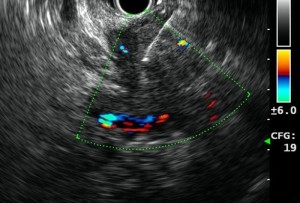 Image of Endoscopic ultrasound (EUS-gastric tract and stomach) 超聲波內視鏡（食道及胃）相片