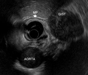 Image of Upper gastrointestinal tract submucosal tumors 上消化道黏膜下腫瘤相片