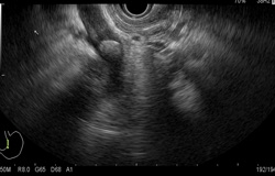 Image of Common bile duct (CBD) stone  膽總管結石 相片
